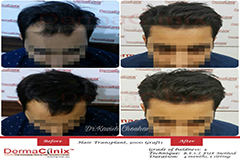 hair transplant results after 4 months