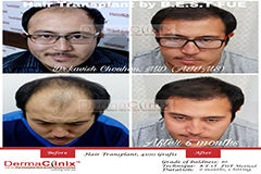 hair transplant results in delhi by dr kavish chouhan