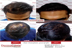 hair transplant results in delhi