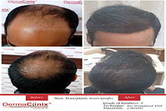 hair-transplant-results-in-south-delhi