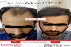 hair transplant reviews