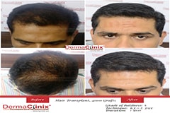 hair transplantation before after results