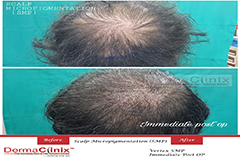 scalp micropigmentation before after
