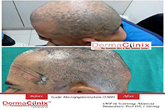 scalp micropigmentation results