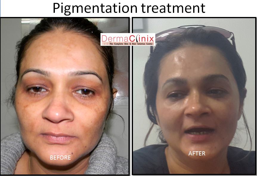 Tattoo Removal Before After Results, Skin Pigmentation Results Delhi