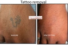 Laser tatoo removal before after Delhi