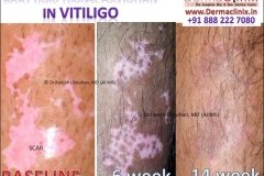body hair transplant results in vitiligo
