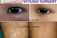 vitiligo surgery before after results