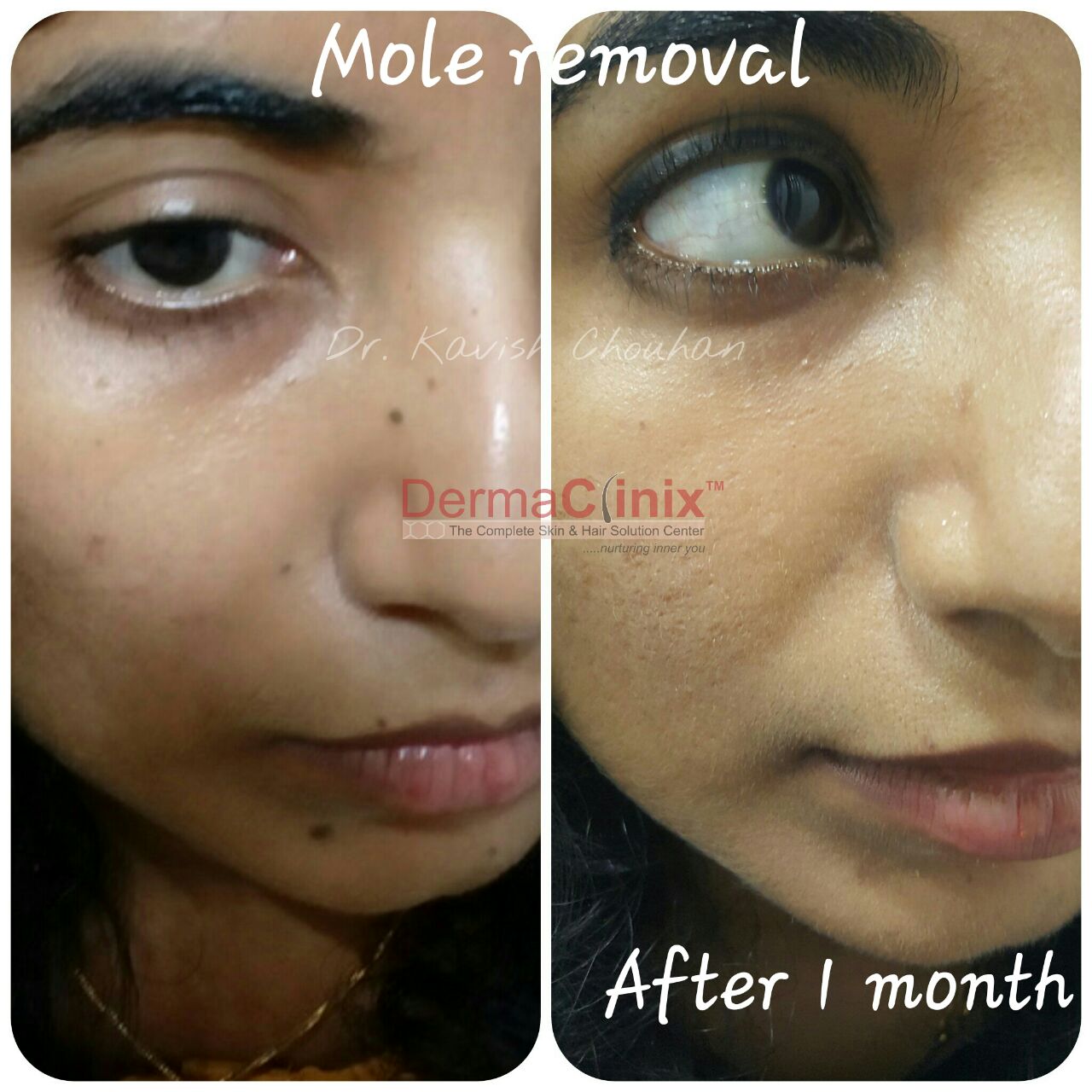 Wart Treatment Before After Results, Mole Removal Patient ...