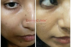 laser mole removal before and after results delhi