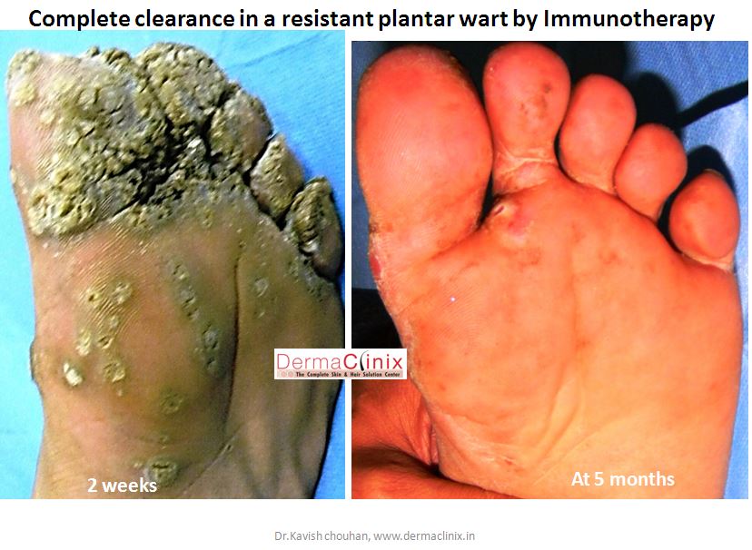 Wart Treatment Before After Results, Mole Removal Patient ...