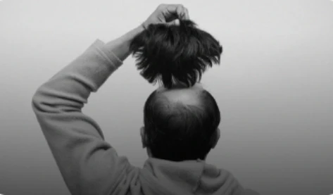 Doctor marking a patient's scalp before a hair transplant procedure