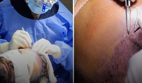 Doctor marking a patient's scalp before a hair transplant procedure