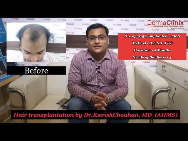 Before and after hair transplant result, patient identity blurred for privacy