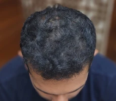 Patient 1 scalp after hair transplant