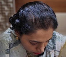Patient 2 scalp after hair transplant