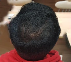 Patient after hair regeneration
