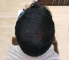 Patient after hair regeneration