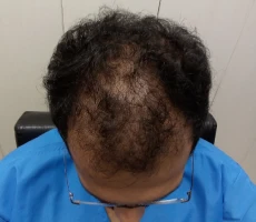 Patient 1 scalp before hair transplant
