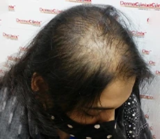 Patient 2 scalp before hair transplant
