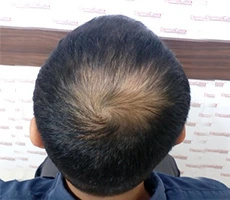 Patient before hair regeneration