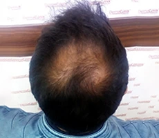 Patient before hair regeneration