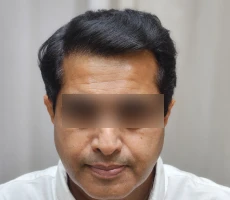 Patient after hair transplant