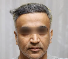 Patient after hair transplant