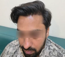 Patient after hair transplant