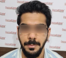 Patient after hair transplant