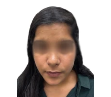 Patient after hair transplant