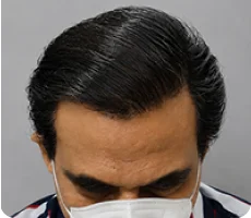 Patient 1 scalp after hair transplant