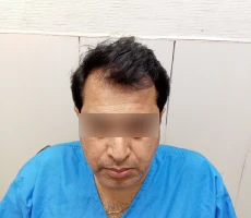 Patient before hair transplant
