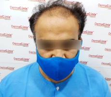 Patient before hair transplant