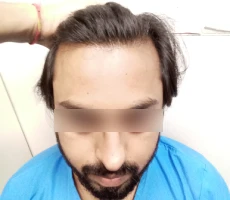 Patient before hair transplant
