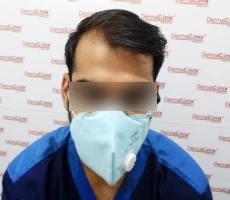 Patient before hair transplant