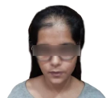Patient before hair transplant