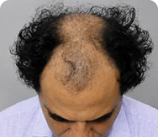 Patient 1 scalp before hair transplant