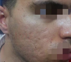 Patient 4 scalp after hair transplant