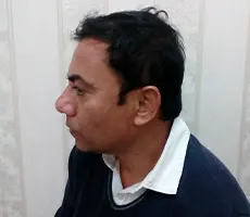 Patient 5 scalp after hair transplant