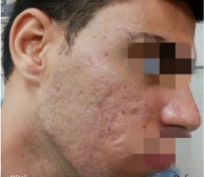 Patient 4 scalp before hair transplant
