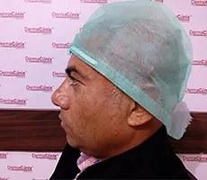 Patient 5 scalp before hair transplant