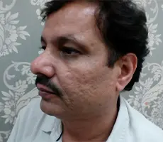 Patient before skin treatment
