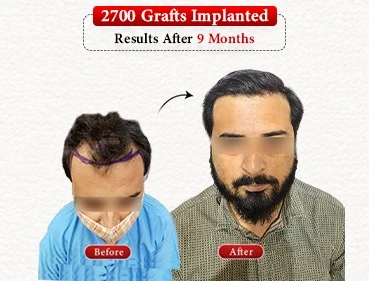 Before After Result