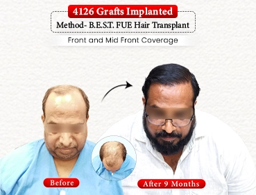 Before After Result