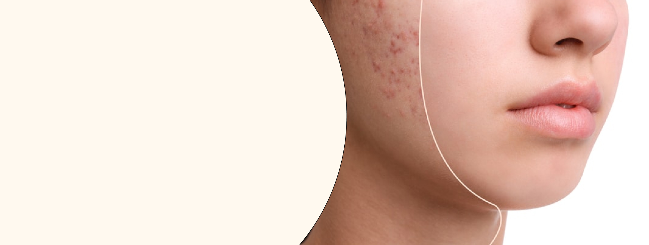 HD-PRP Therapy